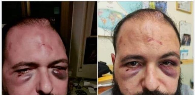 Aggressione neofascista al Vomero, insegnante malmenato a sangue per una spilletta con la scritta ‘antifa’